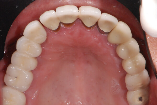 Reconstructive Dentistry Perth - Centre for Prosthodontics