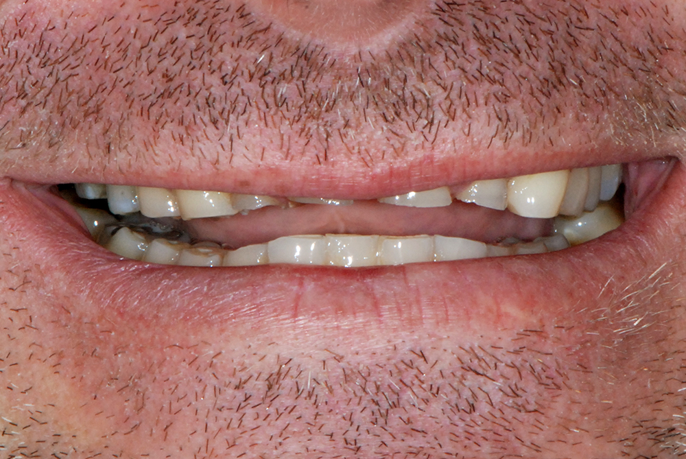 Reconstructive Dentistry Perth - Centre for Prosthodontics